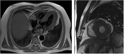 Case Report: First Two Identified Cases of Fabry Disease in Central Asia